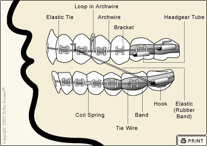 Parts of Your Braces